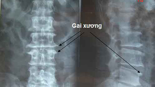 Chụp X quang cột sống thắt lưng