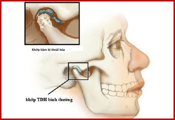 Khớp hàm nối giữa xương sọ và xương hàm