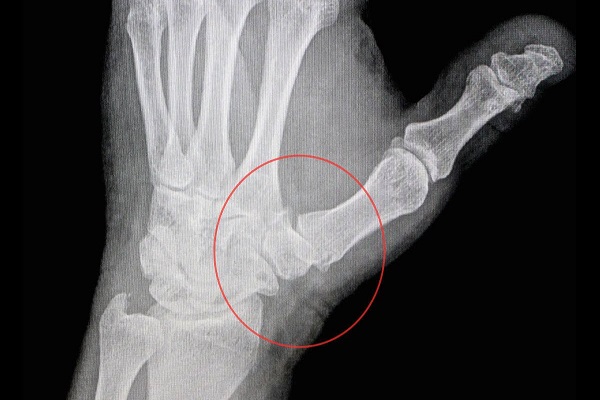 Hình ảnh chụp X-quang của người bệnh thoái hóa khớp tay