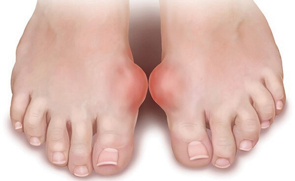 Bệnh Gout là nguyên nhân hàng đầu gây đau ngón chân cái