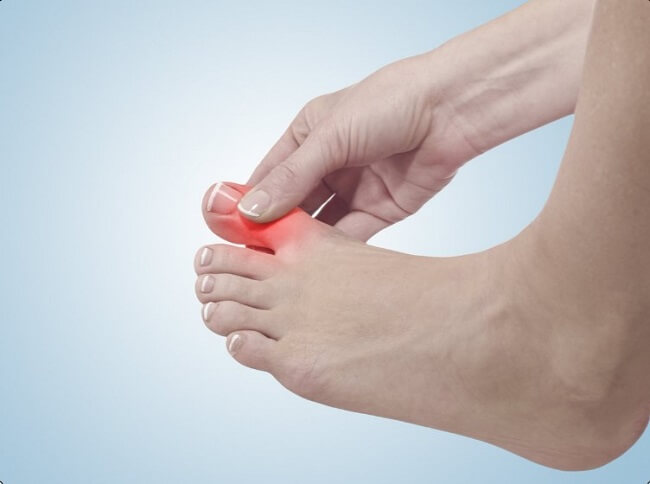 Bệnh gout gây đau khớp ngón chân