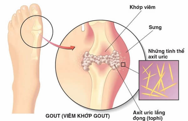 Gout do sự hình thành các tinh thể acid uric