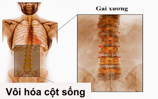 Gai xương xuất hiện ở bệnh nhân vôi hóa cột sống thắt lưng