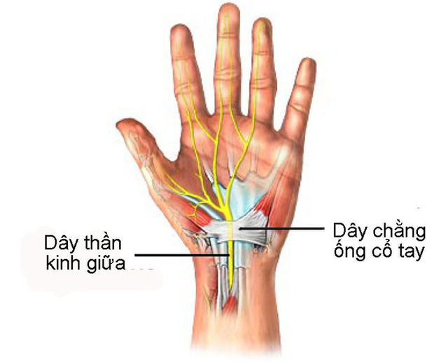 Hội chứng ống cổ tay xuất hiện ở nhiều đối tượng