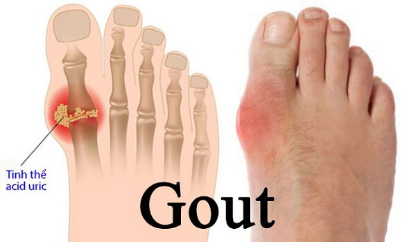 Bệnh Gout cấp tính