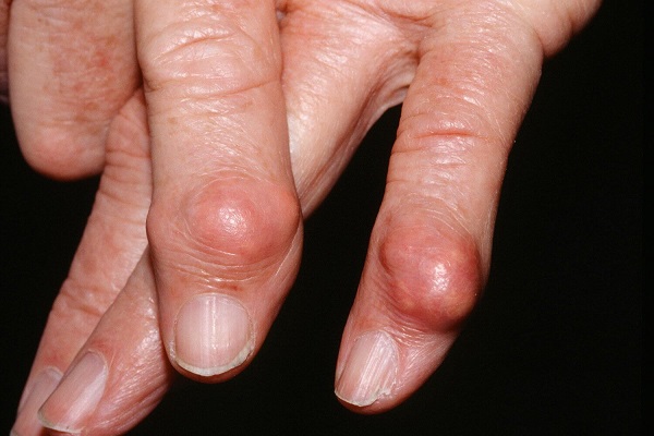 Gout là biến chứng hay gặp ở người bệnh thoái hóa khớp tay di lắng đọng tinh thể urat
