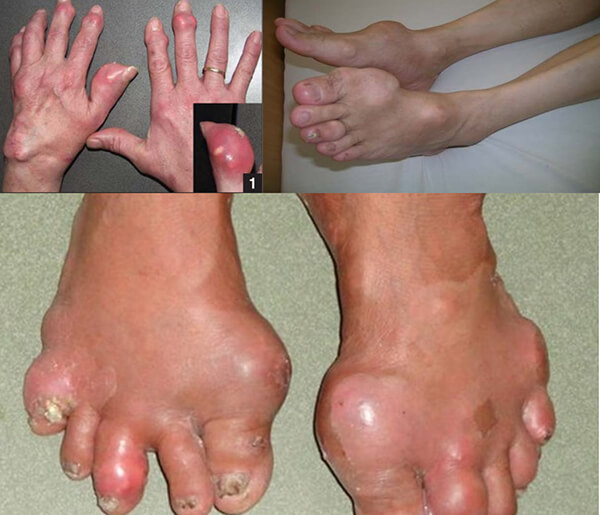Hình ảnh hạt tophi - biến chứng nguy hiểm của bệnh gout mạn