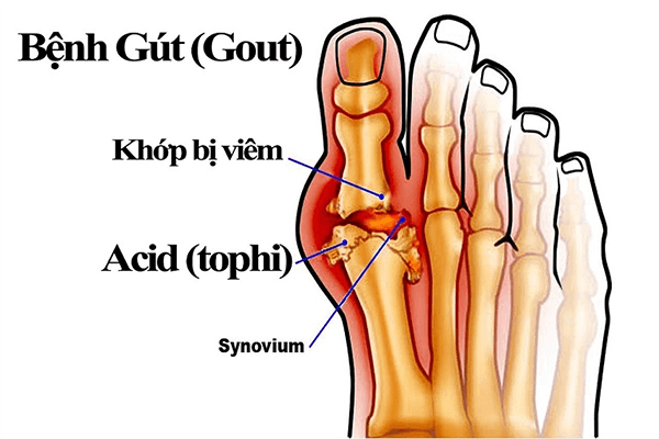 Quá trình hình thành hạt tophi trong bệnh Gout