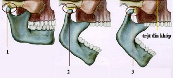 Khớp hàm nối giữa xương sọ và xương hàm