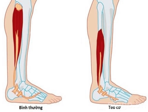Mất khối lượng cơ tại chân ở người thoái hóa khớp gối