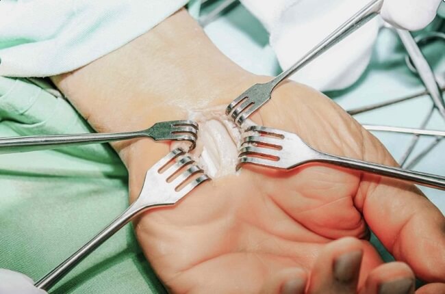 Phẫu thuật hội chứng ống cổ tay