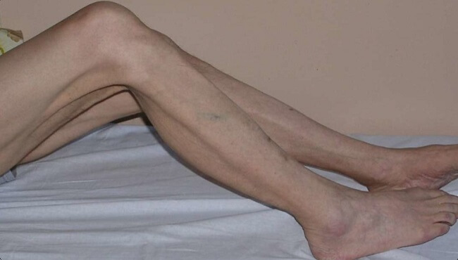 Teo cơ chân là biến chứng có thể gặp ở người bệnh viêm dây thần kinh