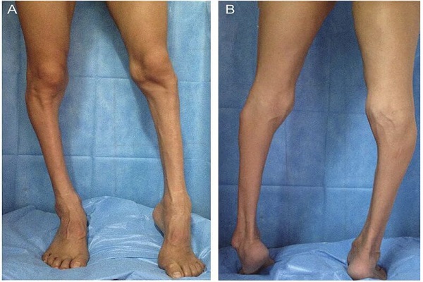 Teo cơ là biến chúng hay xảy ra ở người bệnh thoái hóa khớp chân
