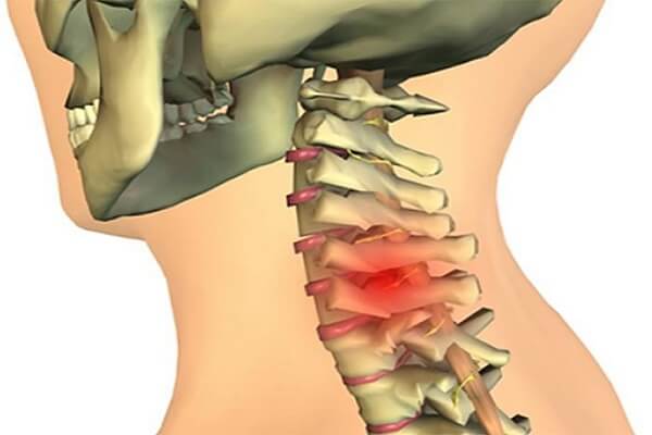 Thoát vị đĩa đệm tại đốt sống cổ