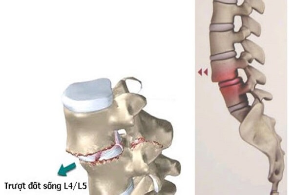 Trượt cột sống thắt lưng thường xảy ra ở đốt sống L4-L5