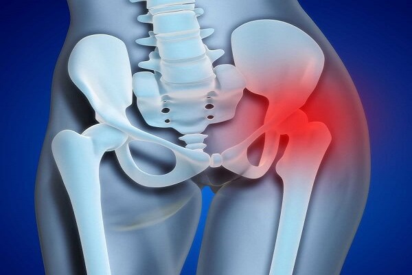 Khớp háng là khớp nối giữa xương chậu và xương đùi