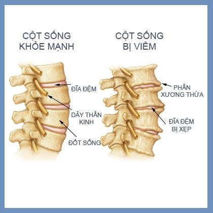 Viêm cột sống dính khớp không phải là bệnh hiếm gặp