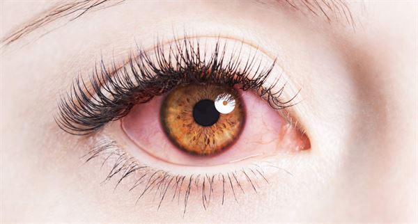 Viêm củng mạc – Biến chứng trên mắt của viêm khớp dạng thấp
