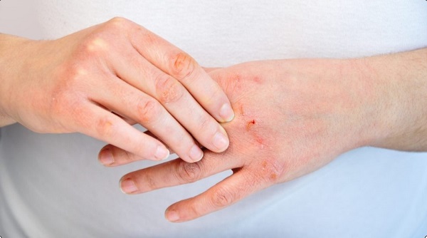 Viêm da có thể xảy ra ở người bệnh sử dụng probenecid