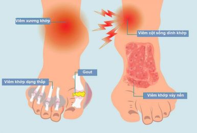 Đau khớp chân: Nguyên nhân và phương pháp điều trị