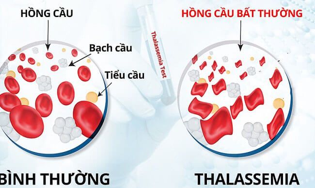 Bệnh tan máu bẩm sinh Thalassemia