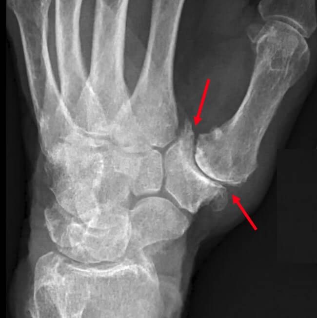 Chụp X-quang khớp ngón tay cái
