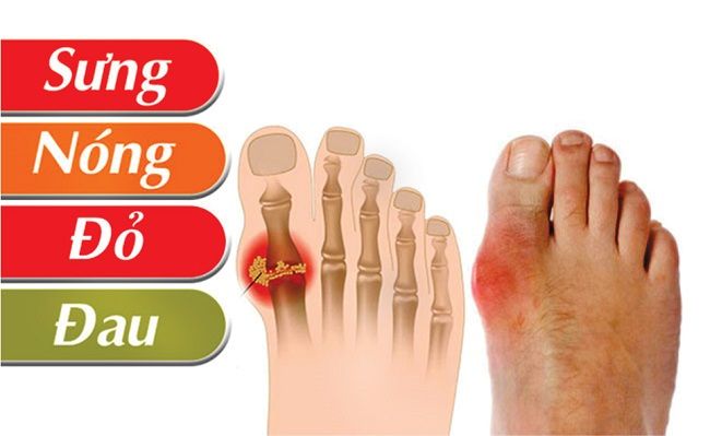 Sưng, nóng, đỏ, đau tại khớp ngón chân cái là dấu hiệu điển hình của gout