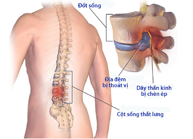 Thoát vị đĩa đệm cột sống thắt lưng gây ra rất nhiều bất tiện cho người bệnh