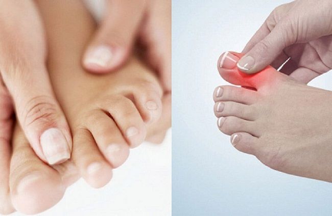 Sưng ngón chân cái có thể là dấu hiệu của bệnh xương khớp nào đó