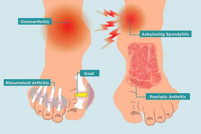  sờ vào khớp chân bị tổn thương do gout bạn có thể sẽ cảm thấy ấm nóng