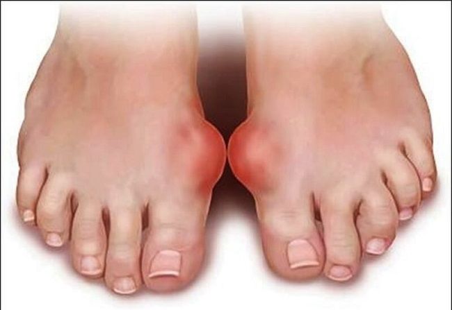 Bệnh gout thường khiến khớp ngón chân cái bị sưng, nóng, đỏ, đau nhức khó chịu
