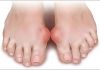 8 Biến chứng của bệnh Gout - Nguy hiểm khôn lường