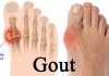 gout cấp tính