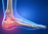 Nguyên nhân gây đau gót chân và cách điều trị hiệu quả