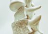 Đo mật độ loãng xương - Phương pháp phát hiện nguy cơ loãng xương