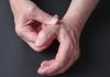 Những điều cần biết về viêm khớp ngón tay cái