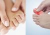 Sưng ngón chân cái có phải dấu hiệu bệnh xương khớp nguy hiểm?
